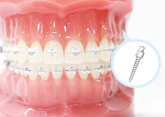 治療プラン一覧 梅田スマイルパートナー矯正歯科